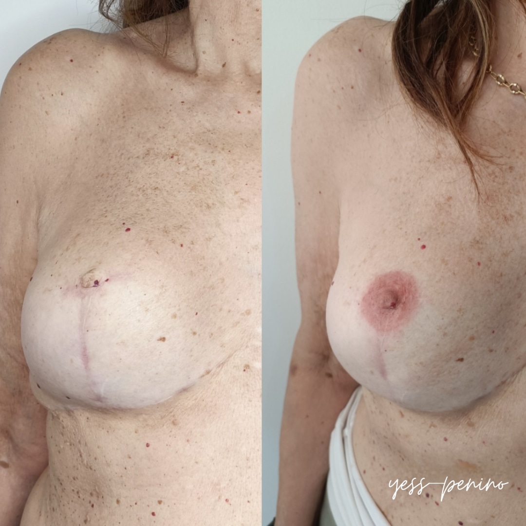 Tatuaje de Reconstrucción Complejo Areola-Pezón Antes y Después