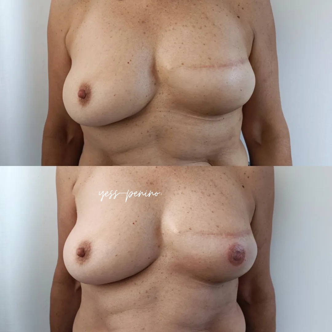 Tatuaje de Reconstrucción Complejo Areola-Pezón Antes y Después