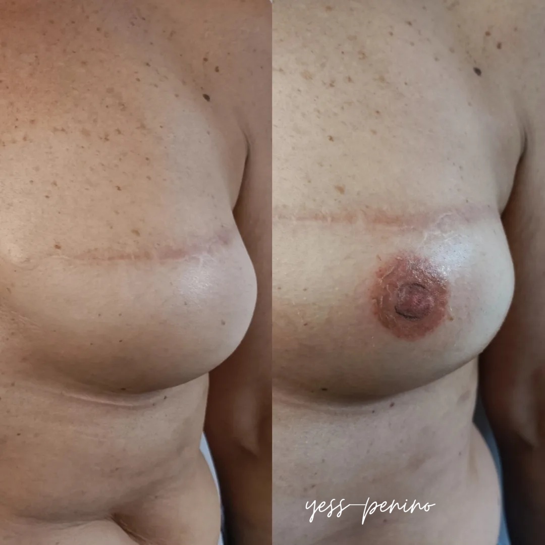 Tatuaje de Reconstrucción Complejo Areola-Pezón Antes y Después