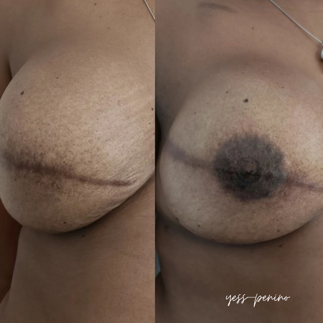 Tatuaje de Reconstrucción Complejo Areola-Pezón Antes y Después