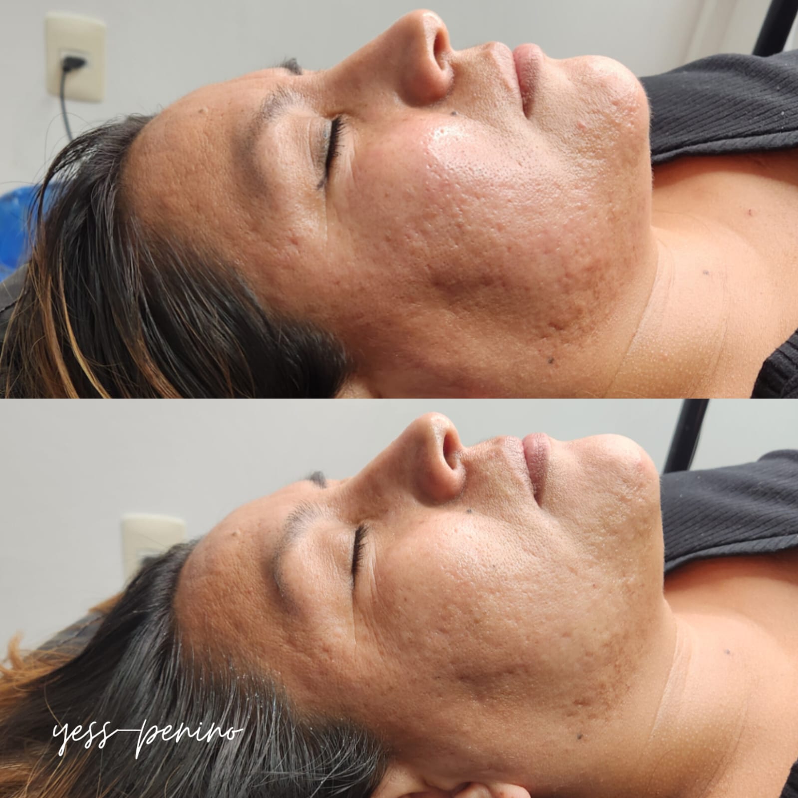 Láser co2 antes y despues (2) Láser co2 antes y despues (2)