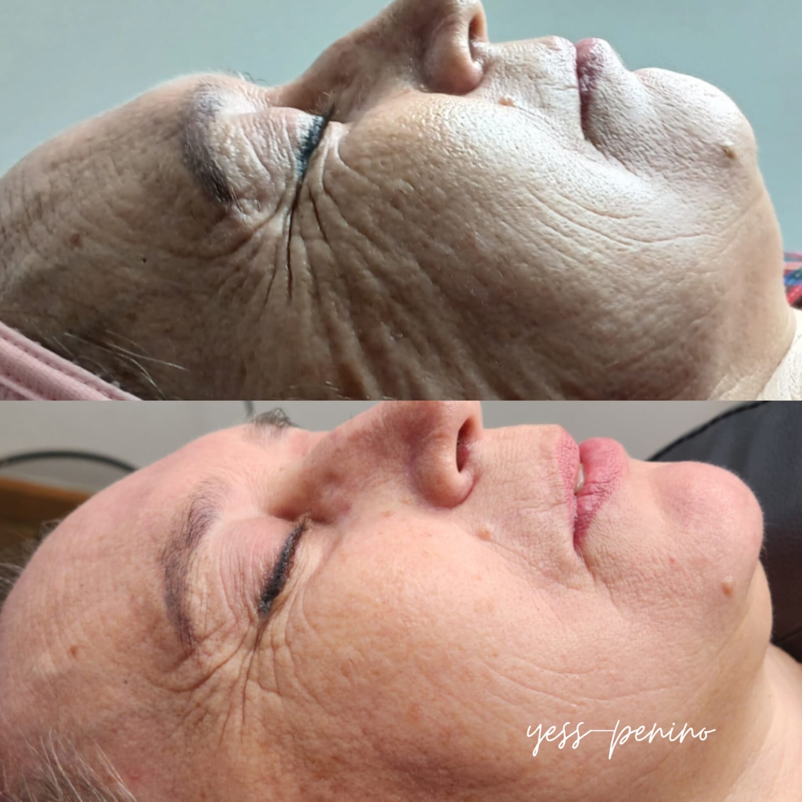 Láser co2 antes y despues (3) Láser co2 antes y despues