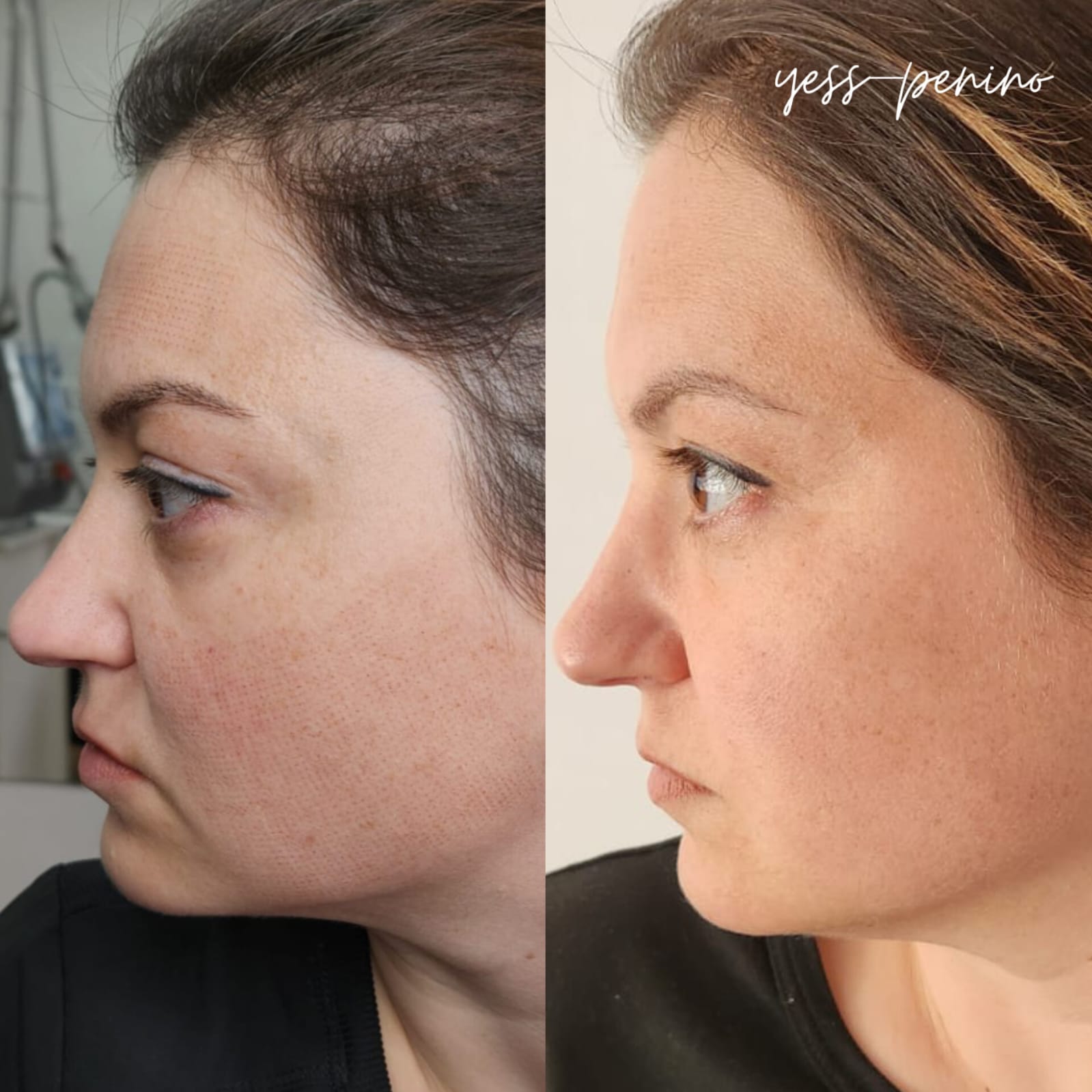 Láser co2 antes y despues (4) Láser co2 antes y despues