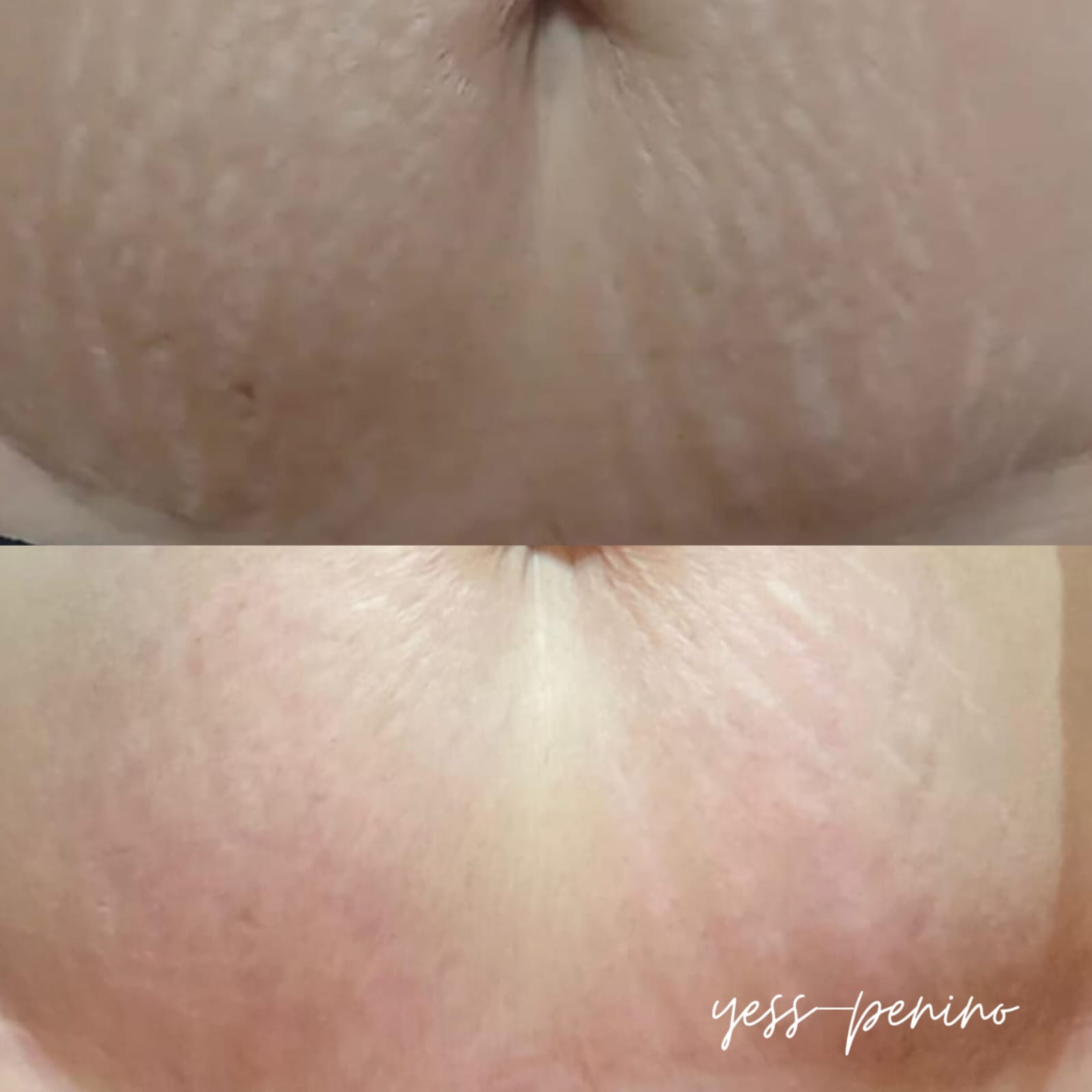 Láser co2 antes y despues (5) Láser co2 antes y despues