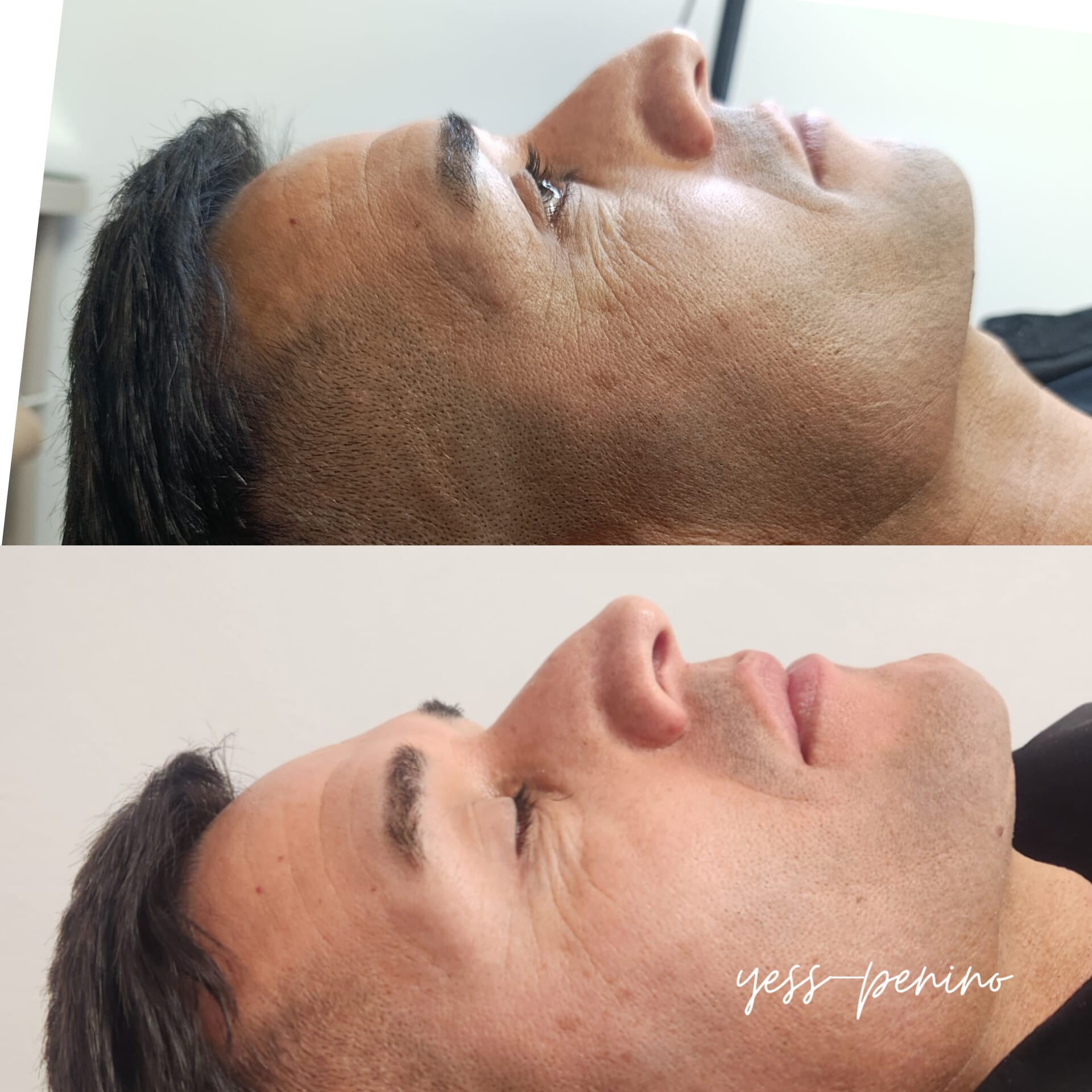 Láser co2 antes y despues (6) Láser co2 antes y despues