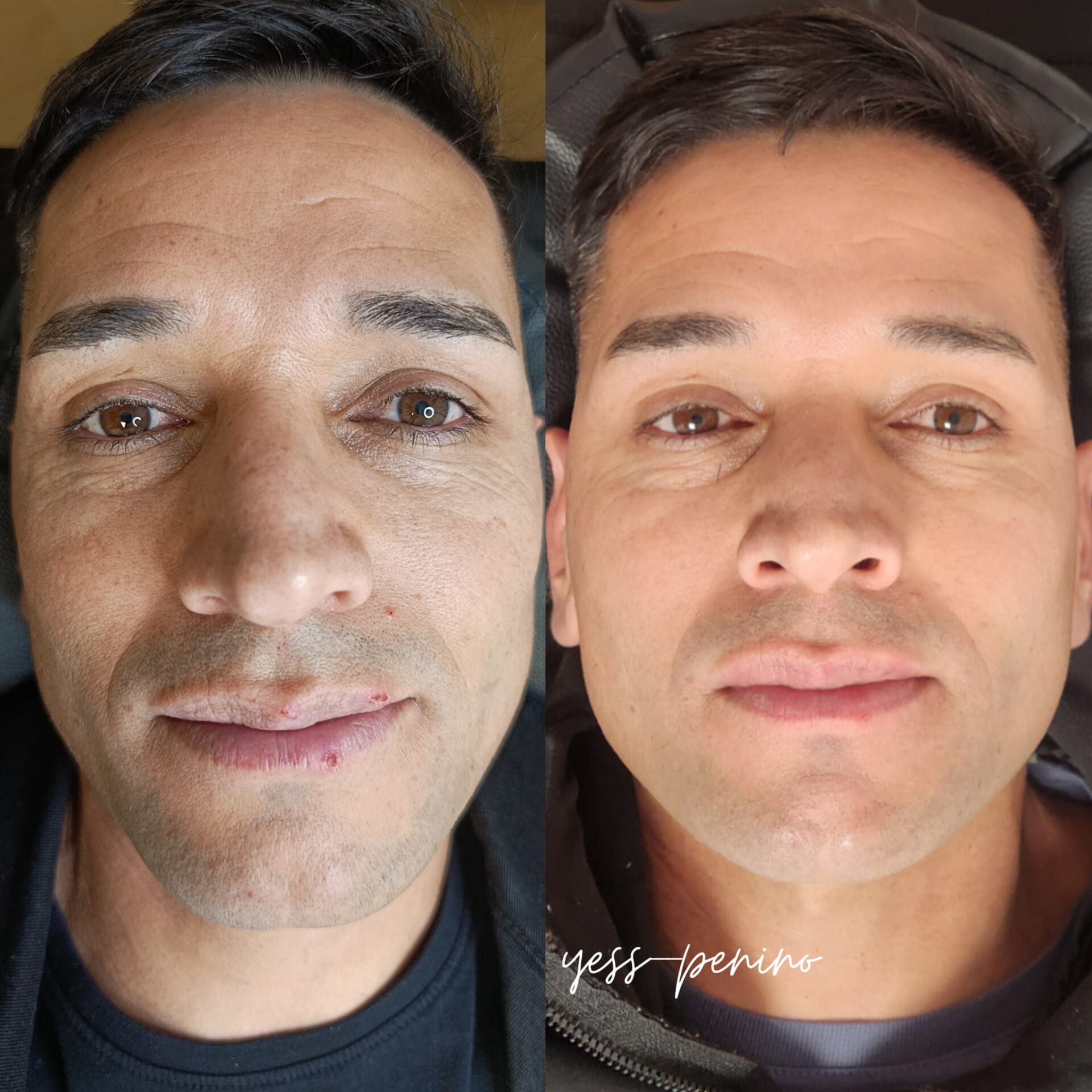 Láser co2 antes y despues (7) Láser co2 antes y despues